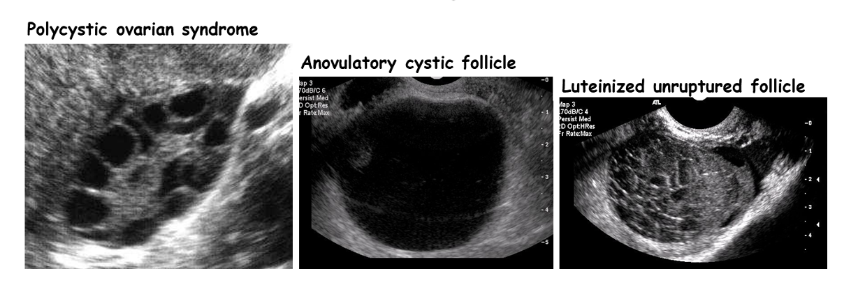 1. Polycystic ovarian syndrome 2. Anovulatory cystic follicle 3. Luteinized, unruptured follicle