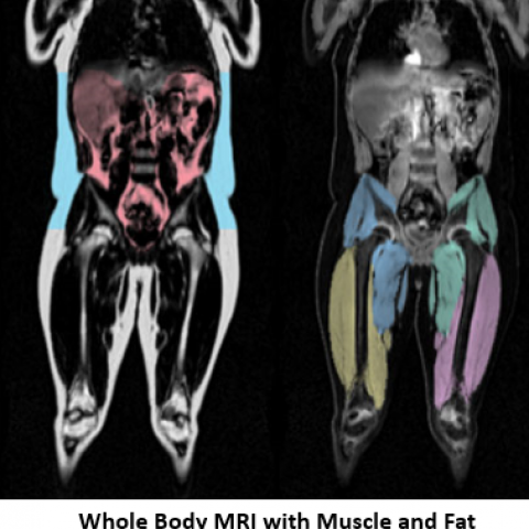 whole body MRI imaging with muscle and fat segmentation