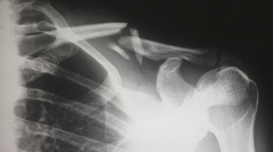 x-ray of broken shoulder area