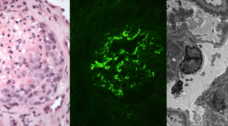 Three pictures from a microscope of kidney lesions.