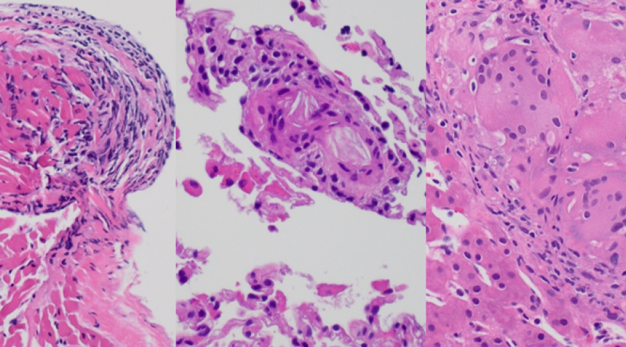 Three pictures from a microscope of liver lesions.