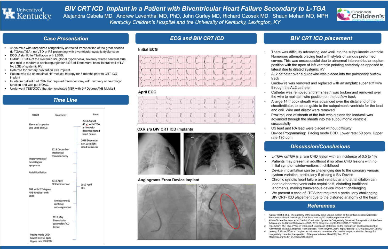 BIC CRT ICD Implant in a patient with Biventricular Heart Failure Secondary to L-TGA, by Alejandra Gabela MD, Andrew Leventhal MD, PhD, John Gruley MD, Richard Czosek MD, Shaun Mohan MD, MPH 