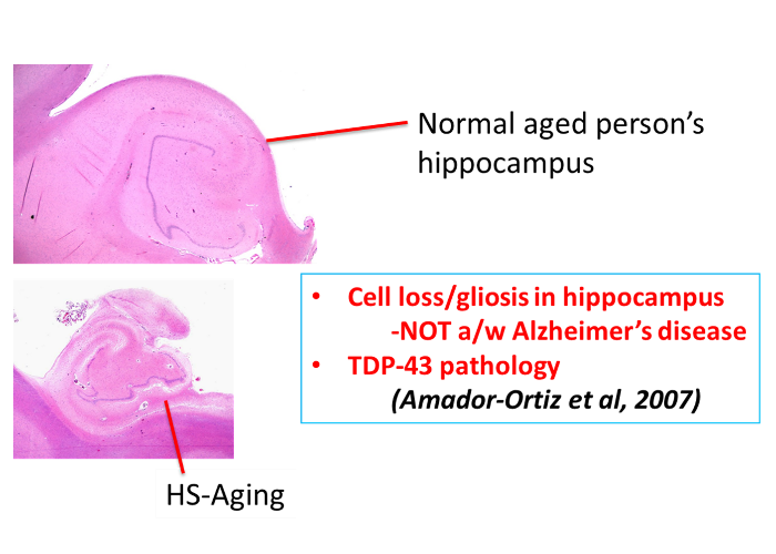 Diagram of Cell loss/gliosis in a normal aged person's hippocampus and HS-Aging