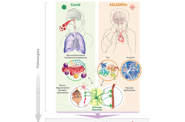 Covid and Alzheimer's disease pathologies