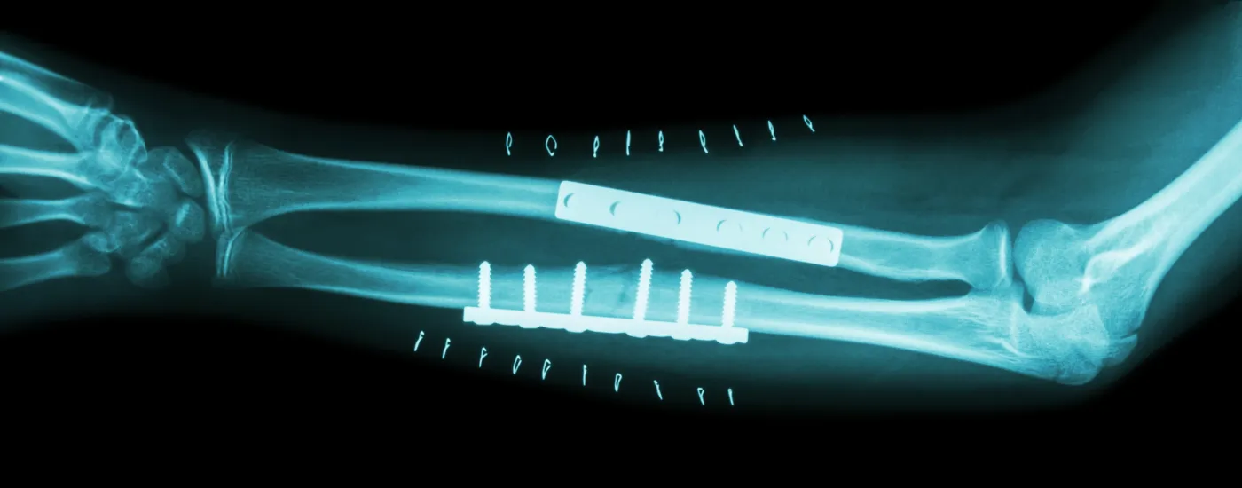 x-ray of forearm; shows pins in arm