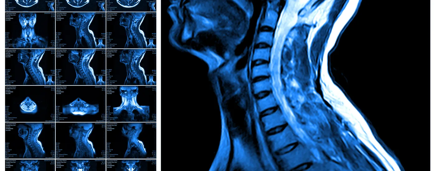 x-ray image of musculoskeletal system of neck and upper spine