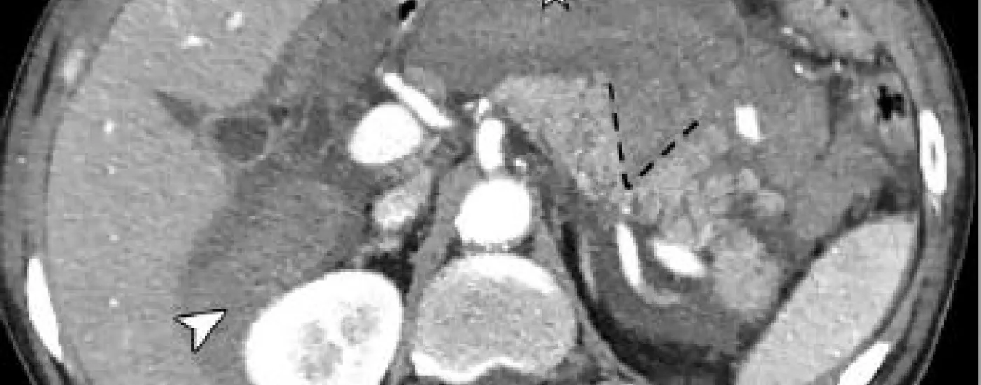 Abdominal xray