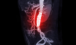 A graphic of an abdominal aorta with stent-grafting.