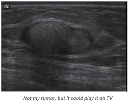 black and white scan of a tumor