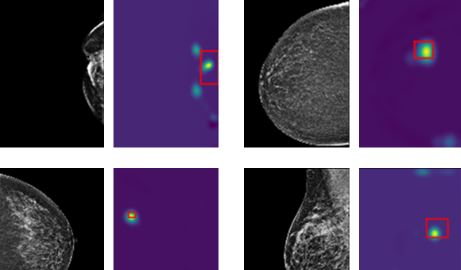 Examples for AI detection of breast cancer on mammograms. 