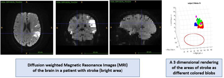 Two images. First one is a diffusion weighted MRI of the brain with stroke. Second is a 3D rendering of the areas of stroke as different colored blobs.