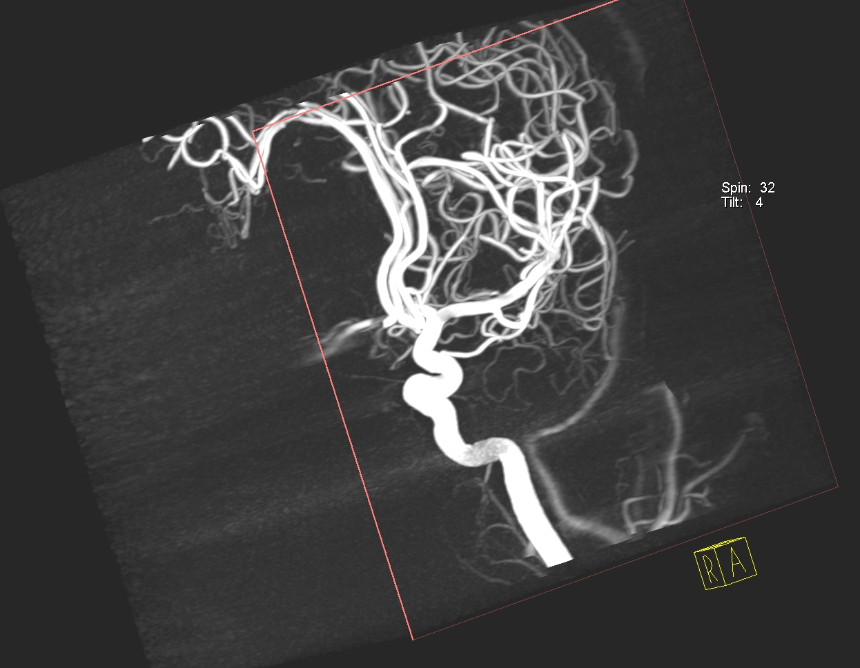 computerized tomography (CT) scan imaging