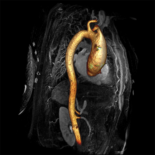 heart's aorta highlighted on scan