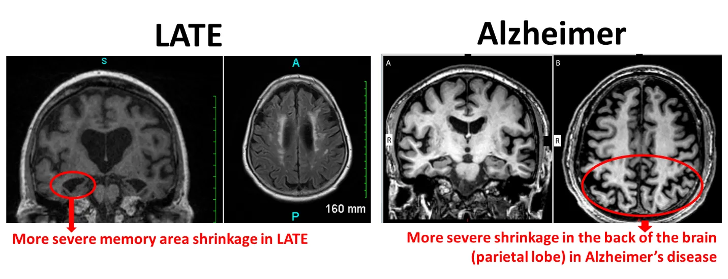 Comparison of brains affected by LATE and brains affected by Alzheimer's: More severe memory area shrinkage in LATE vs. More severe shrinkage in the back of the brain (parietal lobe) in Alzheimer's disease
