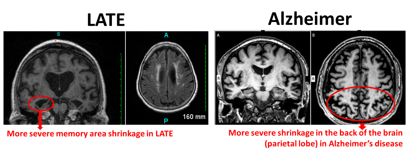 Comparison of brains affected by LATE and brains affected by Alzheimer's: More severe memory area shrinkage in LATE vs. More severe shrinkage in the back of the brain (parietal lobe) in Alzheimer's disease 
