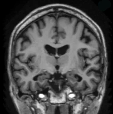 Brain
