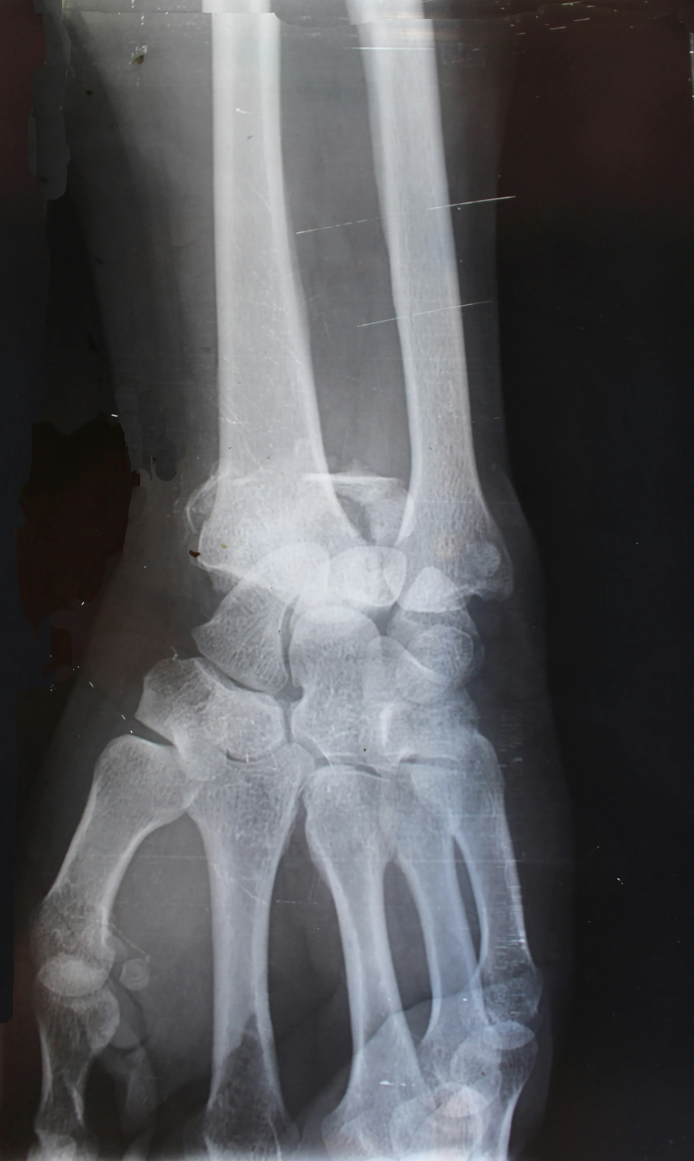 X-ray of a wrist