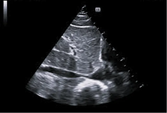 An x-ray of hypovolemia