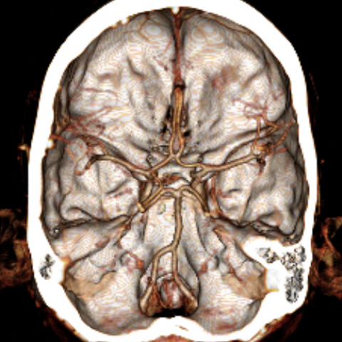 Neuroradiology image of brain