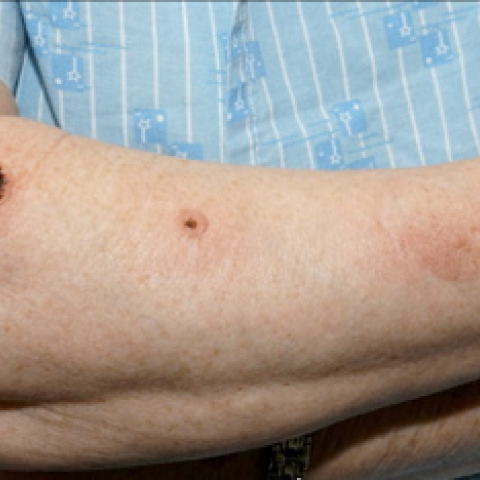 cutaneous anthrax moulage 