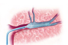 MAVARIC stroke trial medical illustration_0.jpg