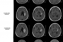 Radiation necrosis scan1_0.jpg