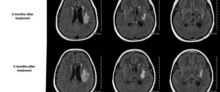 Radiation-necrosis-scan1_0.jpg