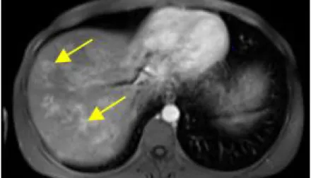 scan of metastatic kaposi sarcoma