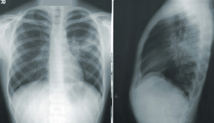 An X-Ray of the human torso