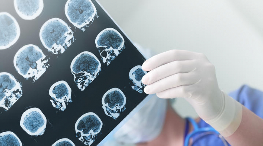 Brain Scans being held by medical professional