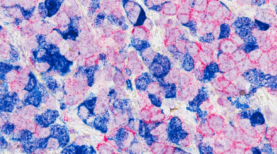 microscope view of cancerous breast tissue