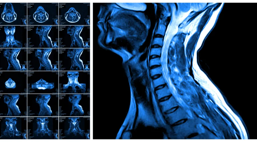 x-ray image of musculoskeletal system of neck and upper spine