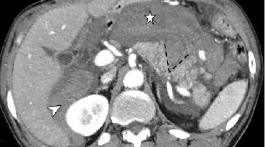 Abdominal xray